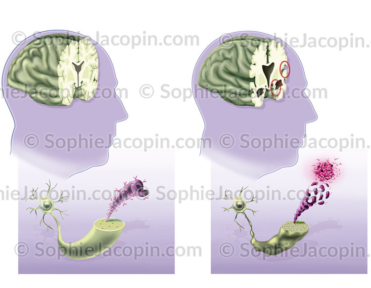 ALZHEIMER – Image 2