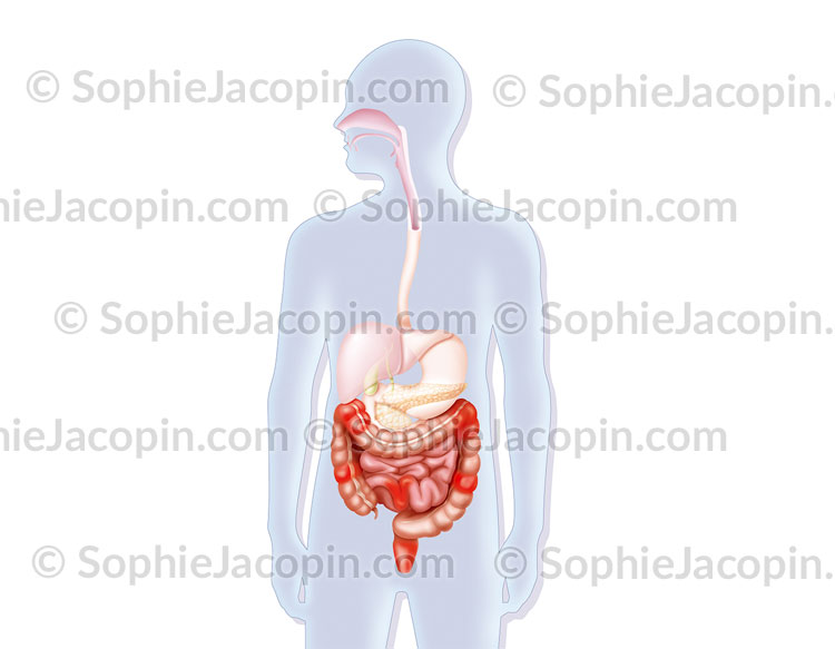 MALADIE DE CROHN – Image 2