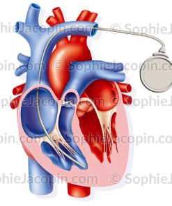 STIMULATEUR CARDIAQUE