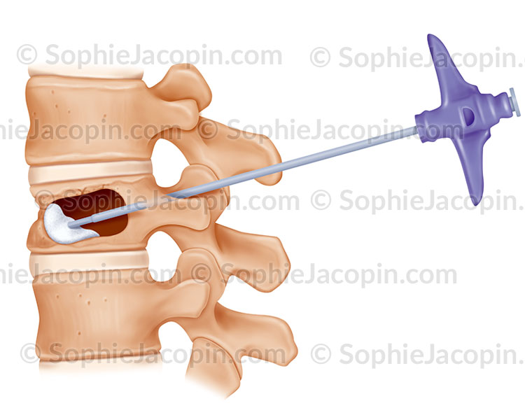 CYPHOPLASTIE, INJECTION DU CIMENT – Image 2