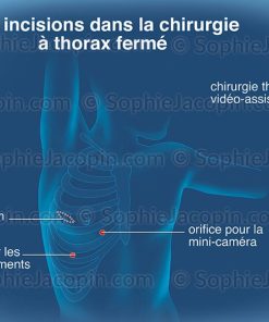 INCISIONS CHIRURGICALES PULMONAIRES