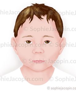 DYSMORPHIE FACIALE – PÉDIATRIE