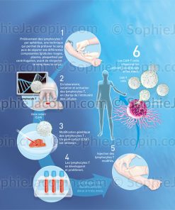 TRAITEMENT CANCER-CELLULES CAR-T